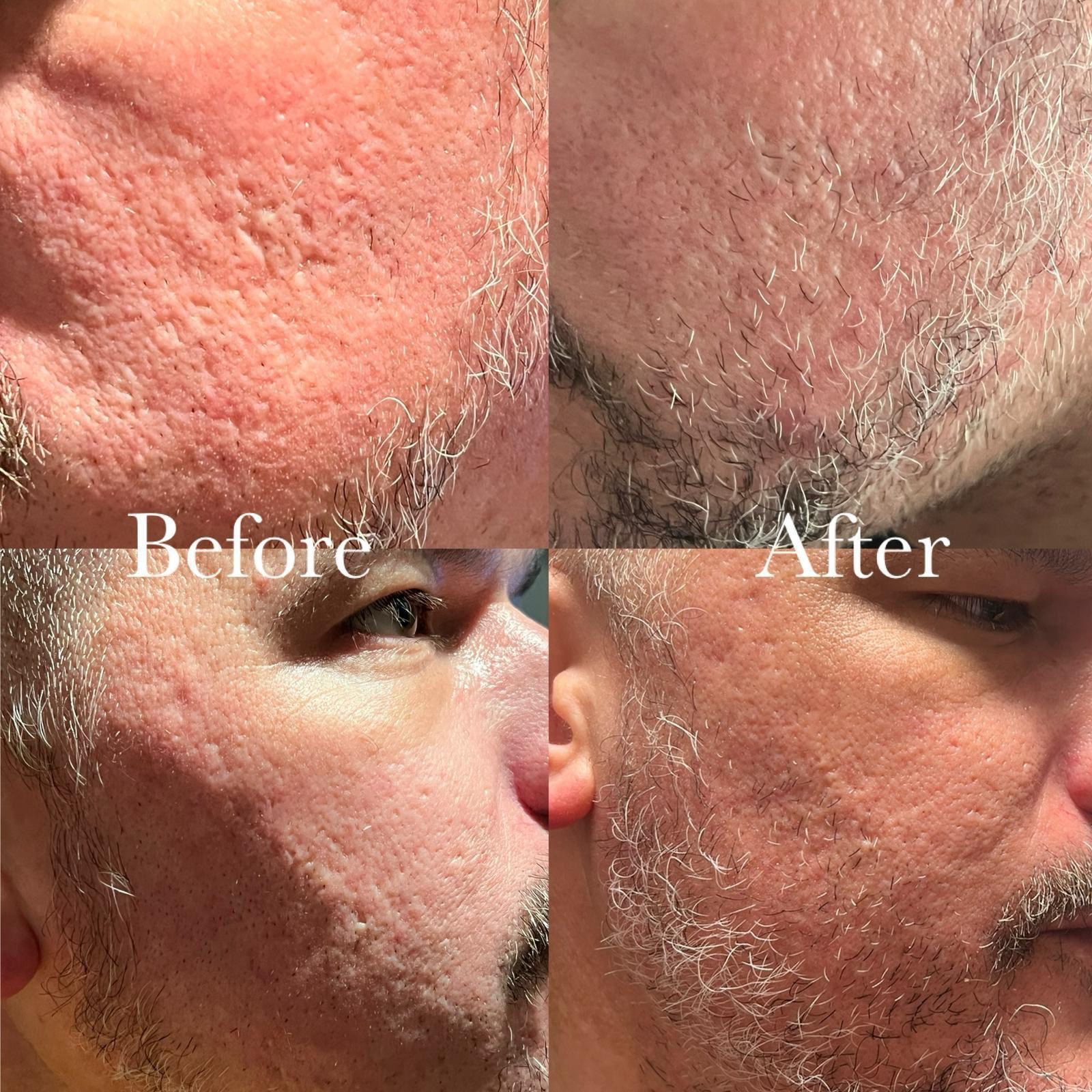 Before and after facial scar camouflage at P31 Studio
