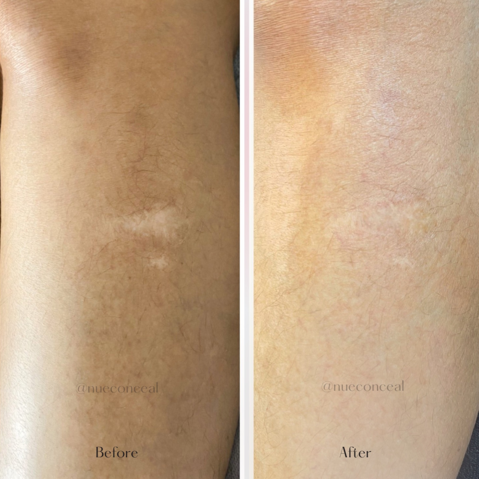 Before and after leg scar camouflage at P31 Studio