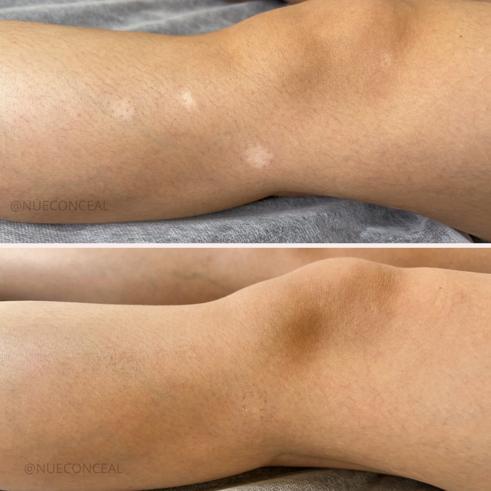 Before and after knee scar camouflage at P31 Studio
