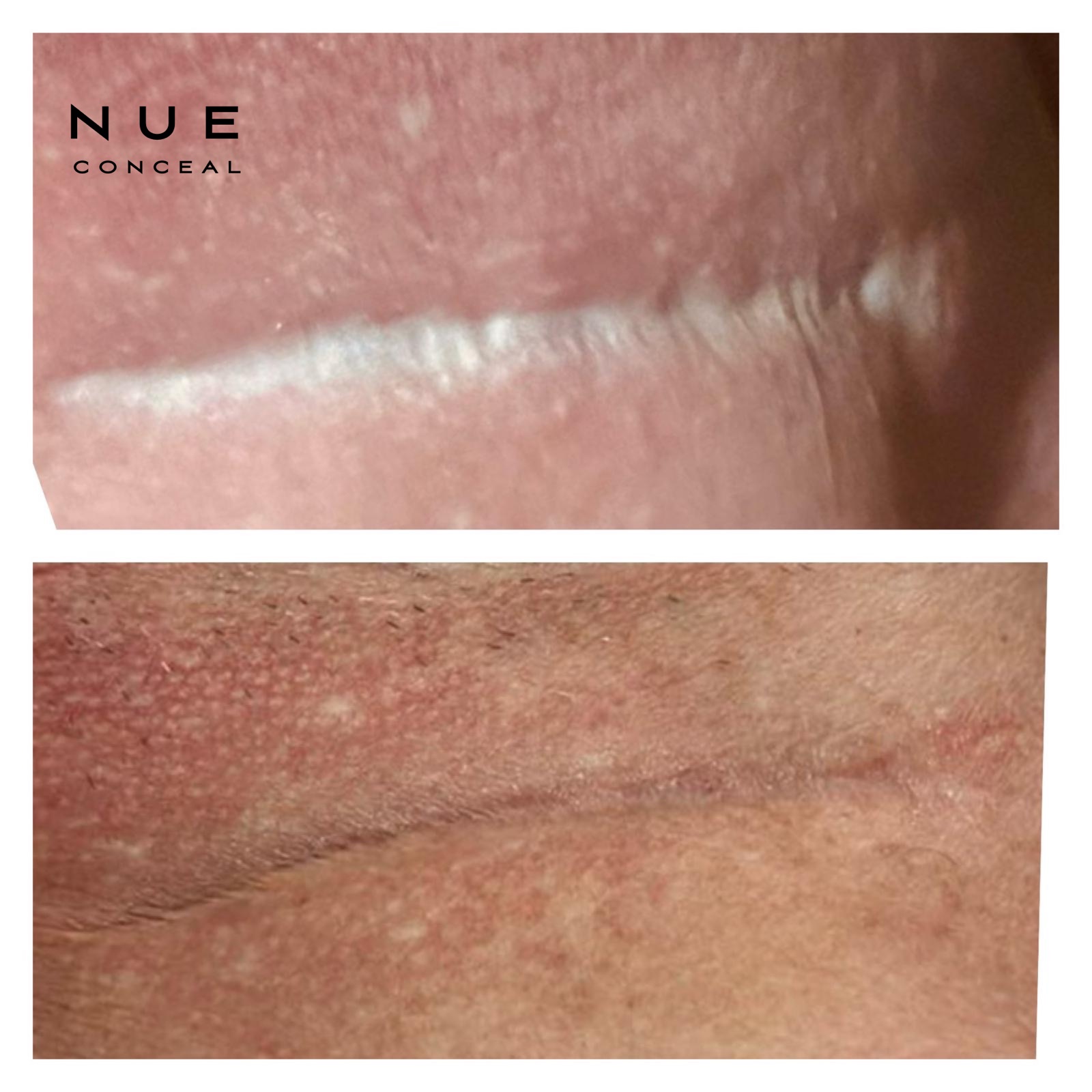Before and after linear scar camouflage at P31 Studio