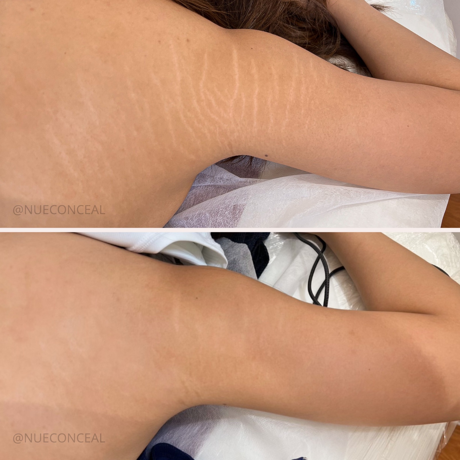 Before and after underarm stretch mark restoration at P31 Studio