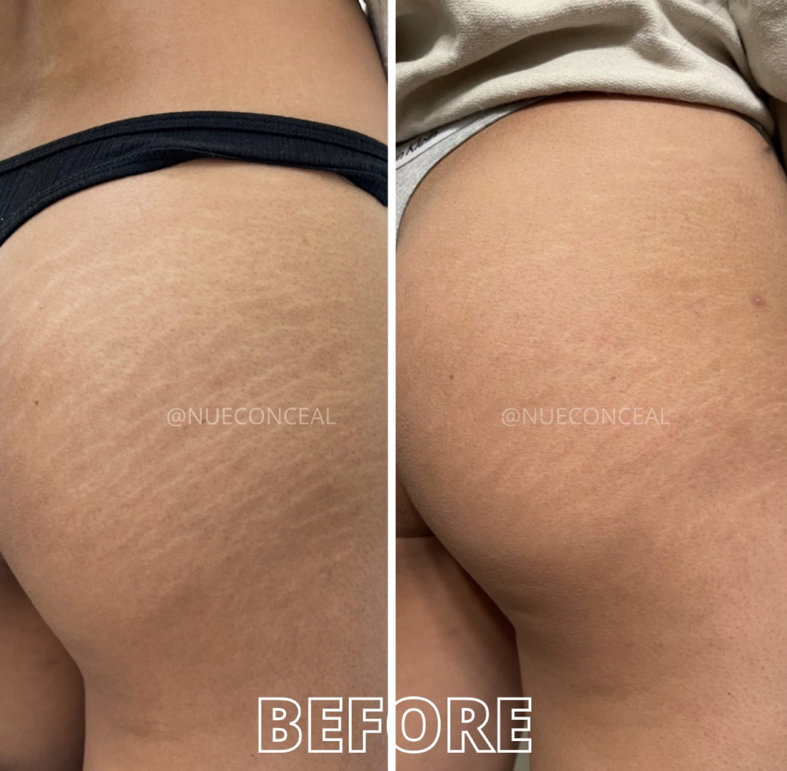 Before and after hip stretch mark restoration at P31 Studio