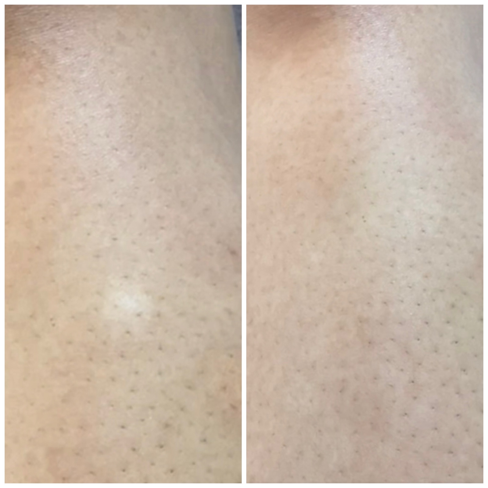 Before and after thigh stretch mark restoration at P31 Studio