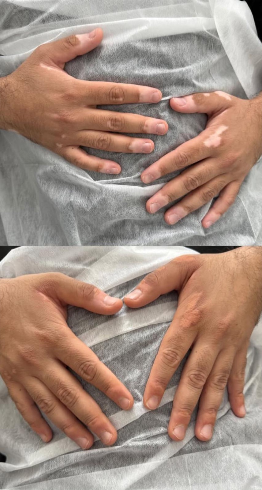 Before and after vitiligo camouflage on hands at P31 Studio